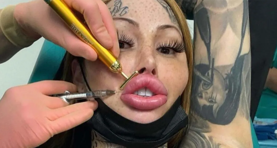 把胸隆炸的网红猝逝!网疑自杀 死前已成外星人 把胸隆炸的网红猝逝!网疑自杀 死前已成外星人