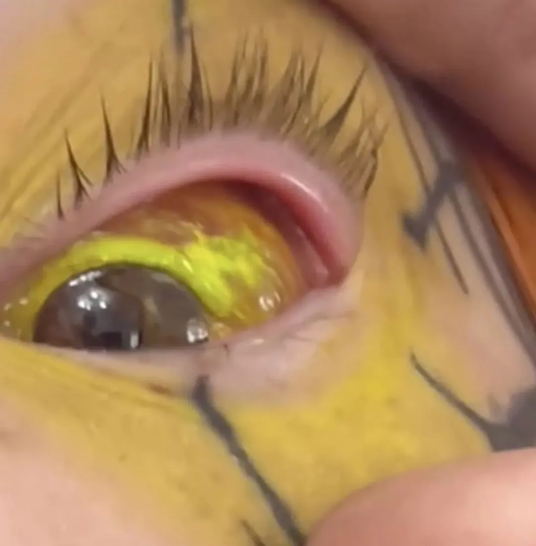 把胸隆炸的网红猝逝!网疑自杀 死前已成外星人 把胸隆炸的网红猝逝!网疑自杀 死前已成外星人