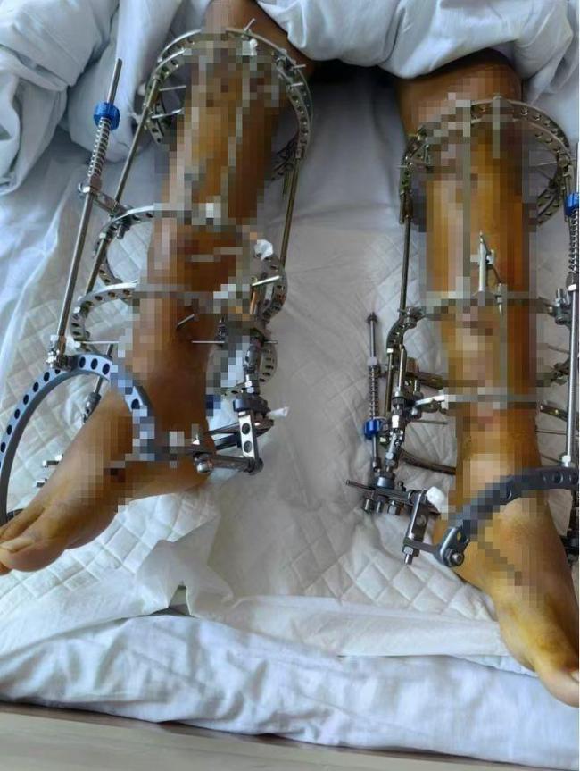 男友妈嫌她矮 20岁女做断骨增高术 10年后太惨