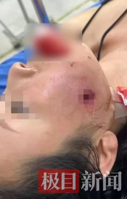 中国游客在泰国脸部中弹 女儿：母亲住院只能吃流食