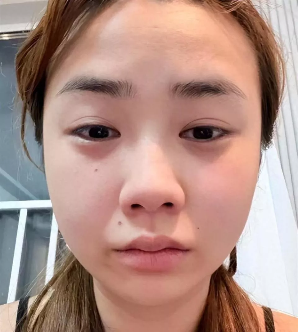 千万网红董赤赤断更5个月后，再出现时面相大变