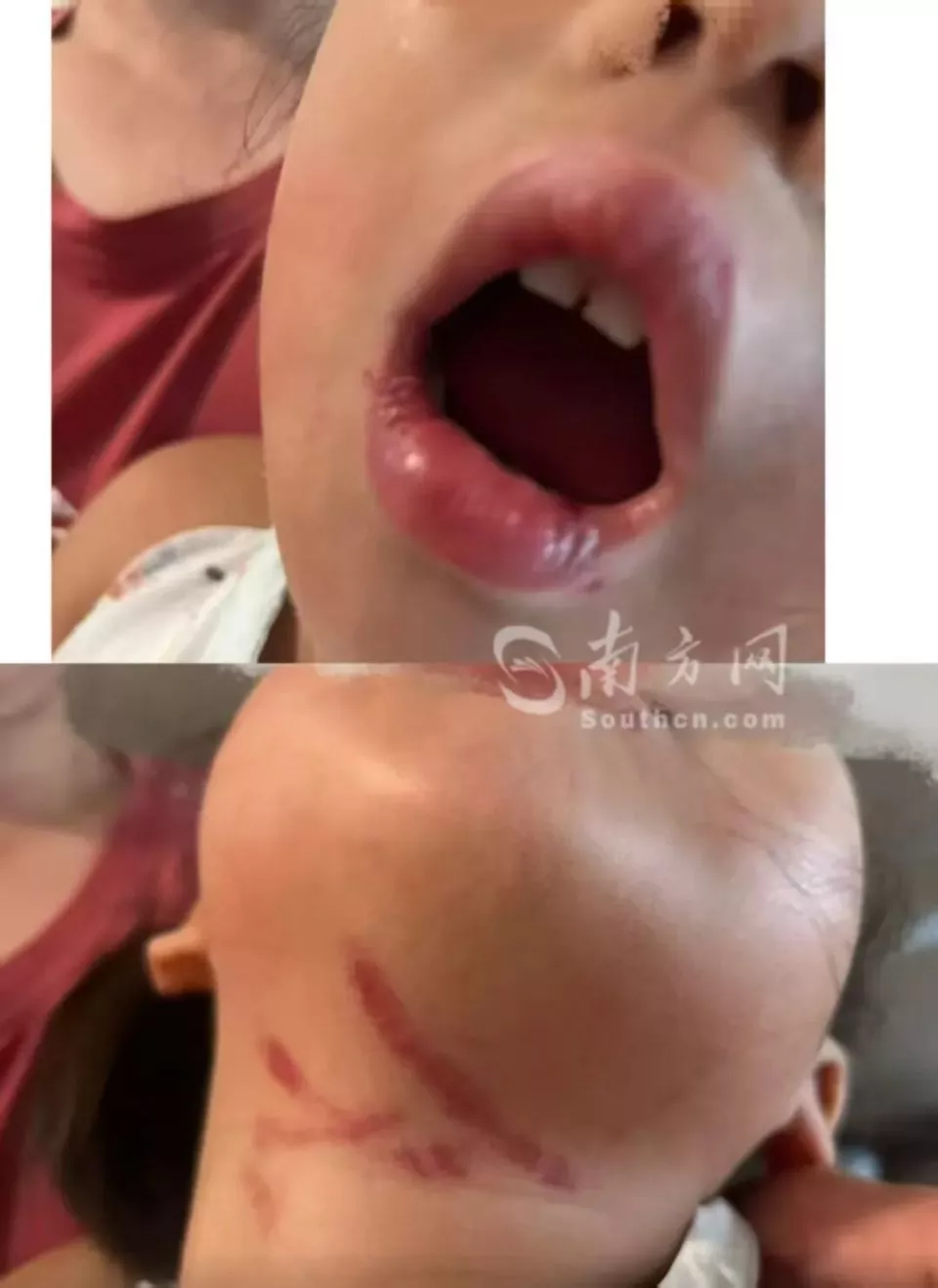 3岁女童疑遭幼儿园男老师暴力喂食受伤,老师被停职