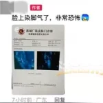 男子健身后脸上染"脚气"，直呼太恐怖！多人曾中招