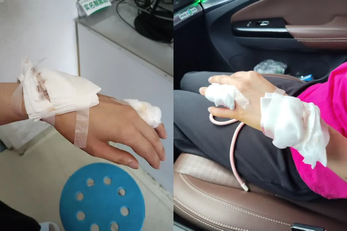 女子称大窑玻璃瓶静置时爆裂,“两根手筋断了”